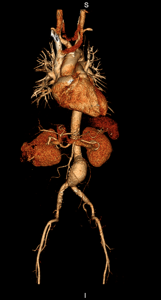 O que é Angiotomografia