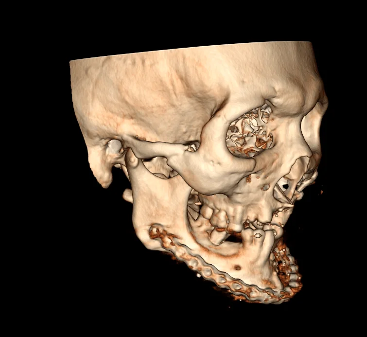 TC DE MANDIBULA • AMD Saúde