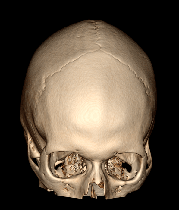 3D CRANIO FRONTAL