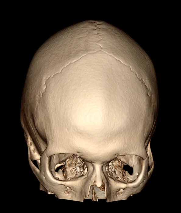 3D CRANIO FRONTAL