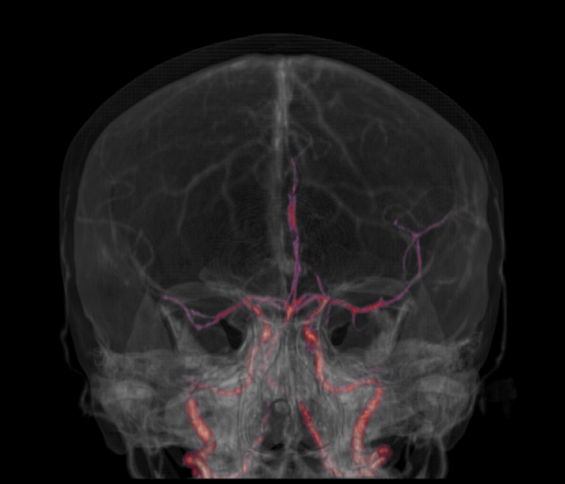 Angiotomografia do crânio