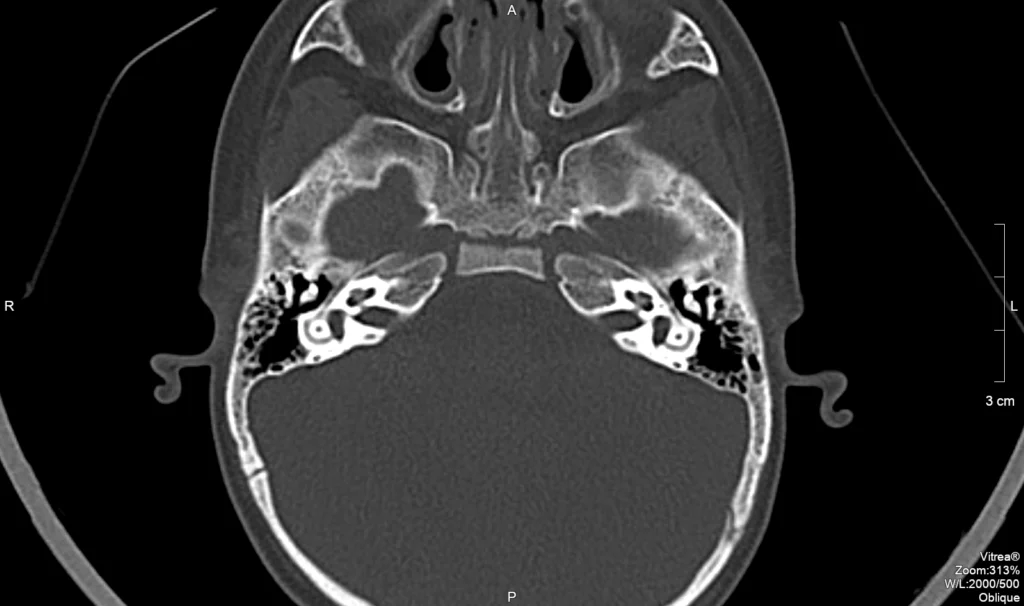 TC DE MANDIBULA • AMD Saúde