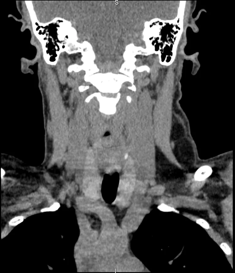 TC DE MANDIBULA • AMD Saúde