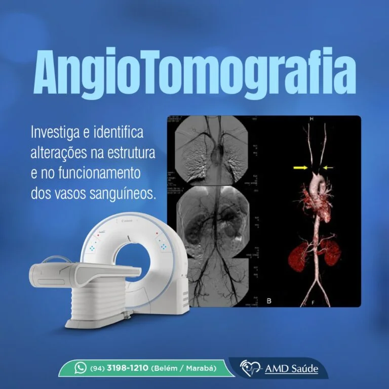 Mastoidite • AMD Saúde