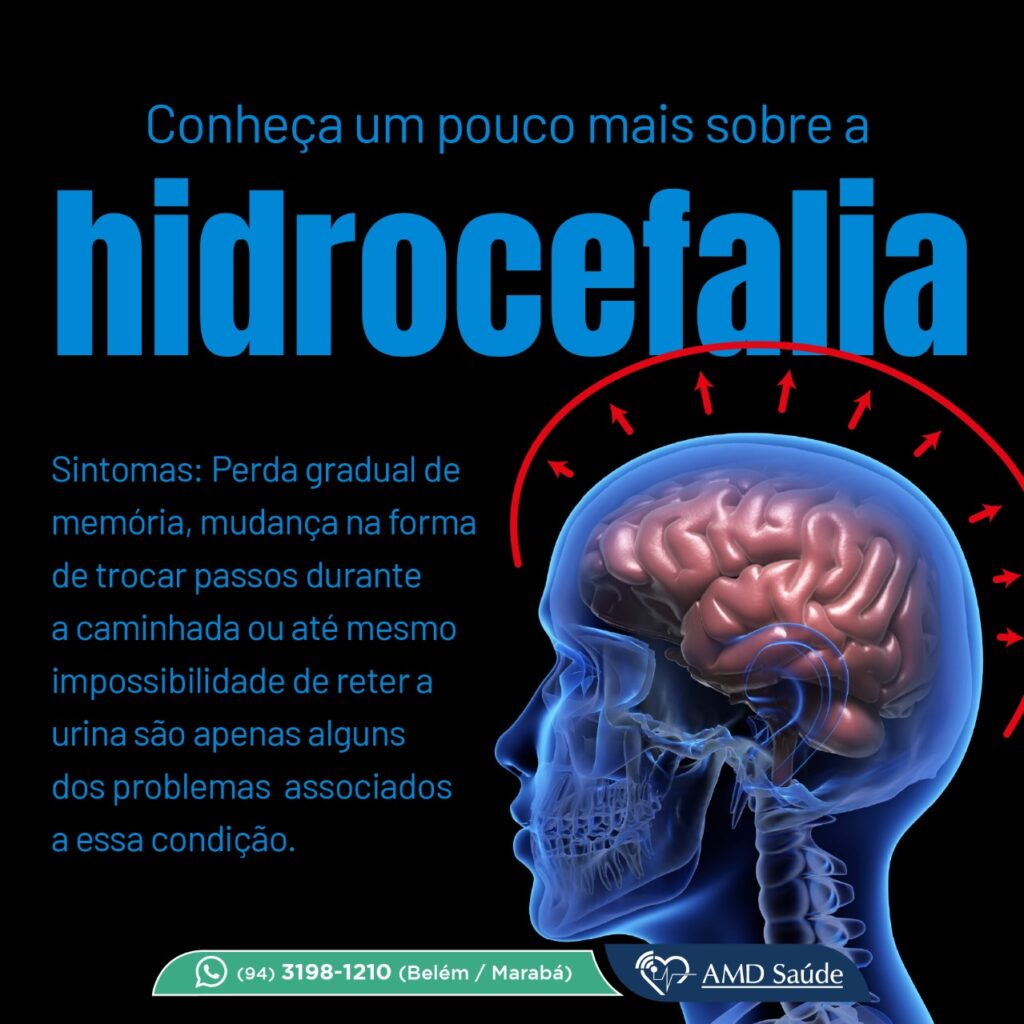 Hidrocefalia • Amd Saúde 2371